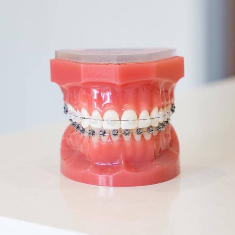 metal braces on plastic typodont model