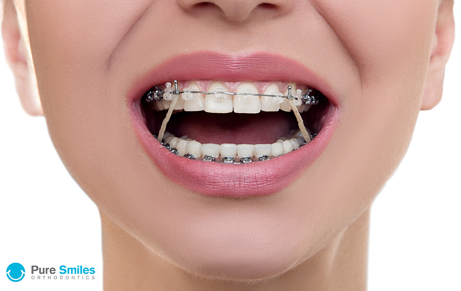 Orthodontic Elastics