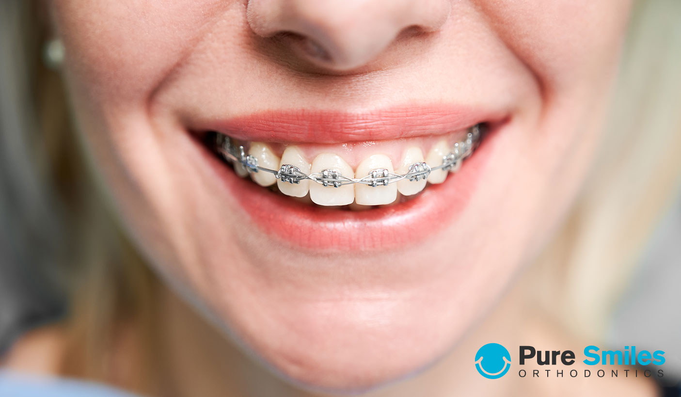 best orthodontic treatment