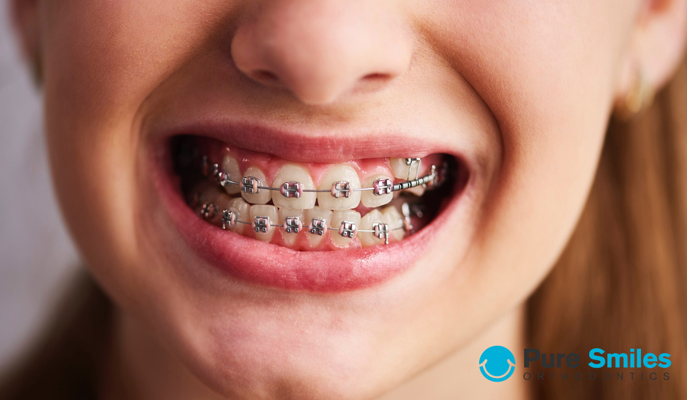 Getting Braces