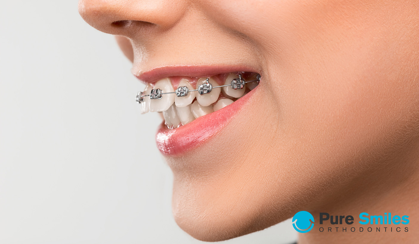 braces for overbite correction