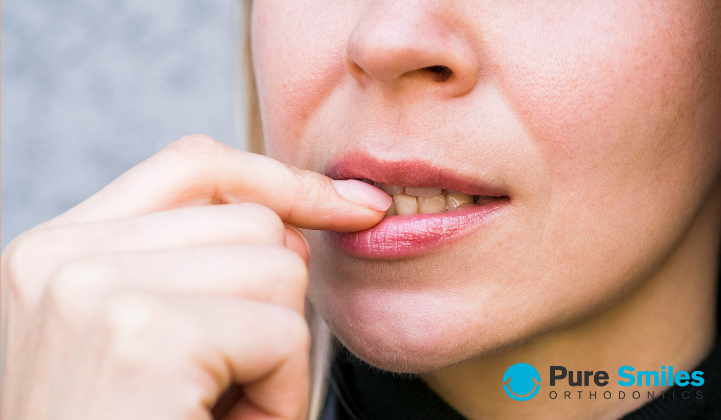 braces staining teeth