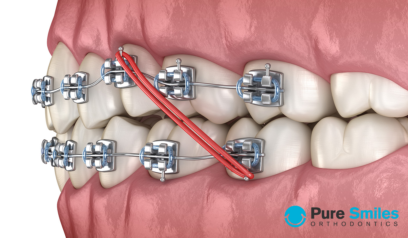 rubber bands braces